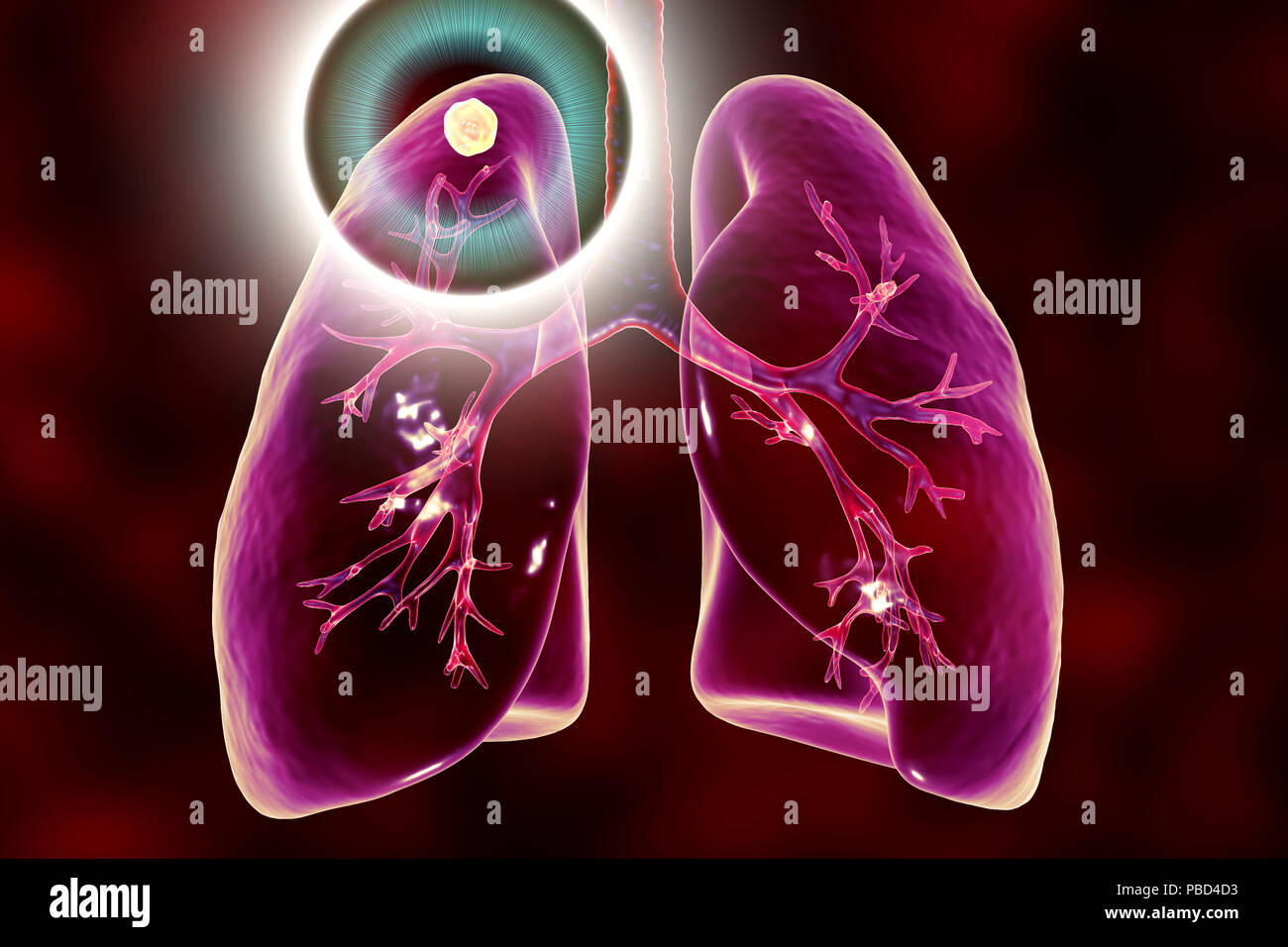 Il trattamento e la prevenzione della tubercolosi, illustrazione concettuale. Foto Stock