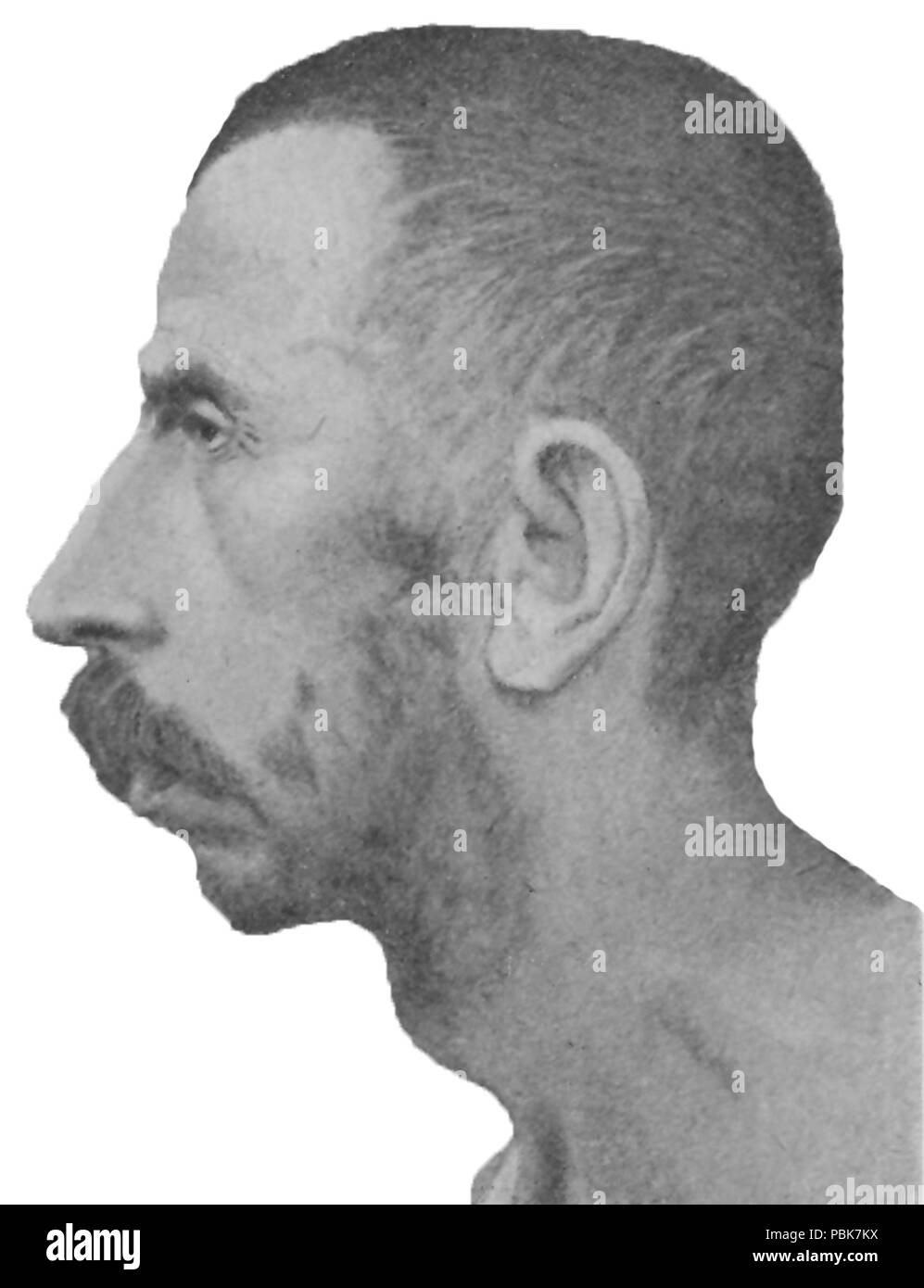 1295 schizofrenia congenita di idiota, 39 anni. Asthenic. Profilo Foto Stock