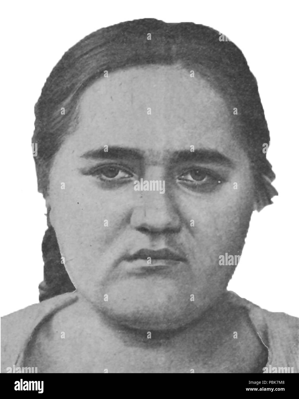 1295 pubertial schizofrenici debole mentale e l'obesità, l'età 19 Foto Stock