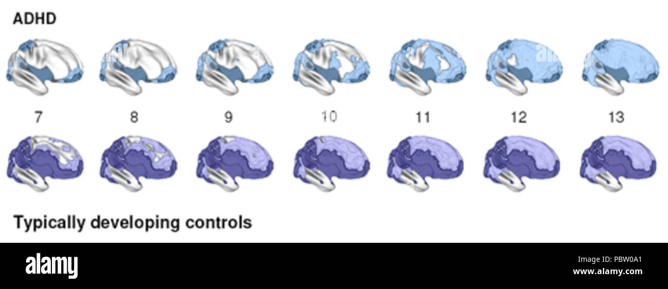 Adhd brain timelapse. Foto Stock