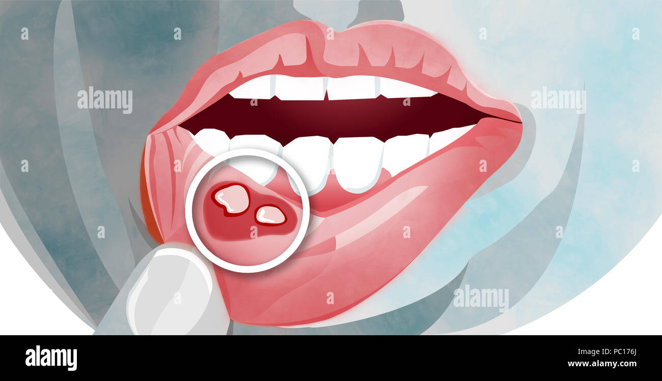 Le stomatiti aftose è una condizione comune caratterizzato dalla ripetuta la formazione di tumori benigni e non contagiosa ulcere della bocca. Afte Foto Stock