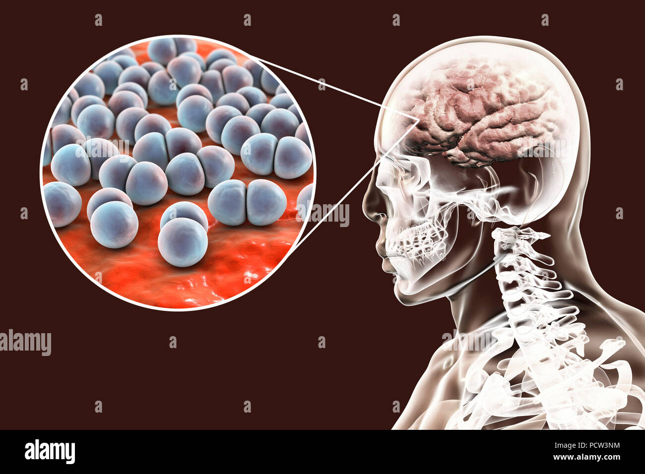 Cervello infezione causata da Streptococcus pneumoniae batteri, illustrazione del computer. S. pneumoniae sono batteri Gram-positivi disposti in coppie (diplococci), essi sono comuni agenti causativi di infezioni di diversa ubicazione, comprese meningite batterica, meningoencefalite e da encefalite. Foto Stock