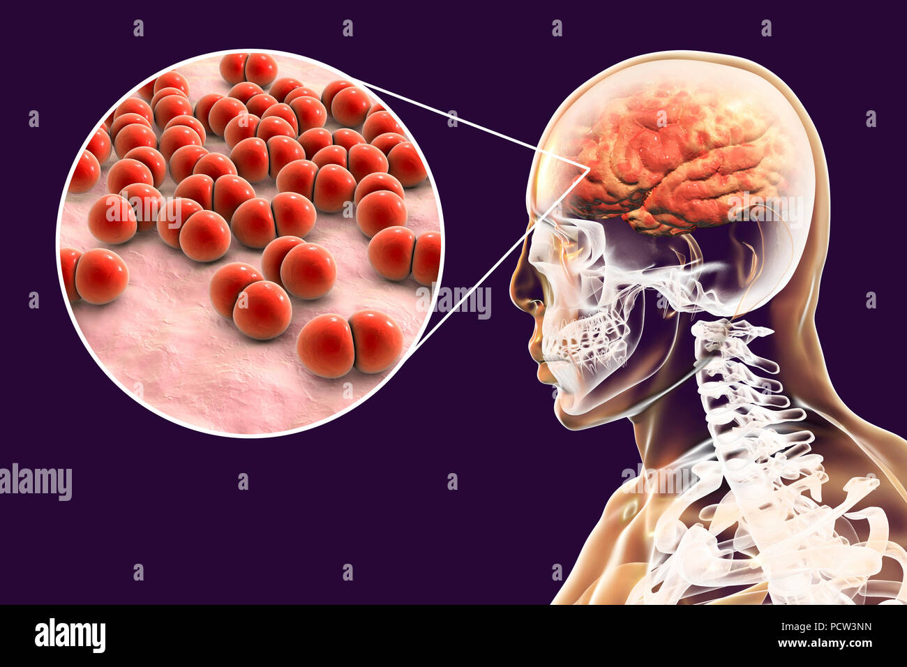 Cervello infezione causata da Streptococcus pneumoniae batteri, illustrazione del computer. S. pneumoniae sono batteri Gram-positivi disposti in coppie (diplococci), essi sono comuni agenti causativi di infezioni di diversa ubicazione, comprese meningite batterica, meningoencefalite e da encefalite. Foto Stock