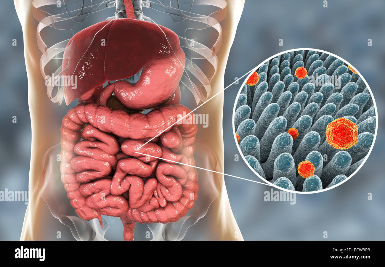 Epatite A virus di infettare l'intestino, illustrazione. Epatite A è trasmesso attraverso gli alimenti infetti o bere. I sintomi includono sintomi influenzali di febbre e malessere, lungo con ittero. Foto Stock