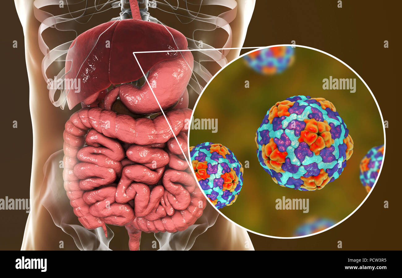 Epatite A infezione. Computer illustrazione che mostra il fegato e vista ravvicinata di epatite A virus. Foto Stock