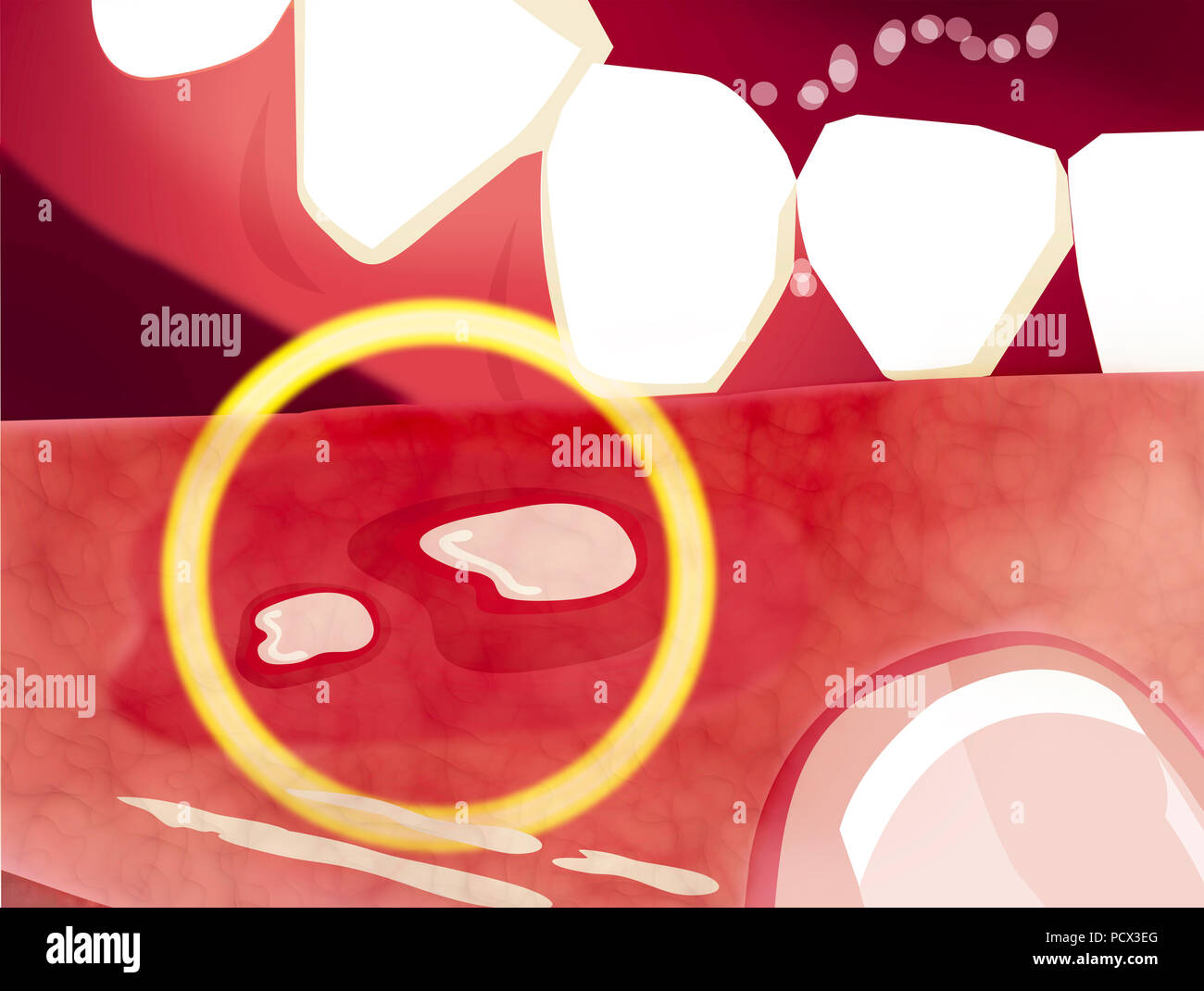 Le stomatiti aftose è una condizione comune caratterizzato dalla ripetuta la formazione di tumori benigni e non contagiosa ulcere della bocca. Afte Foto Stock
