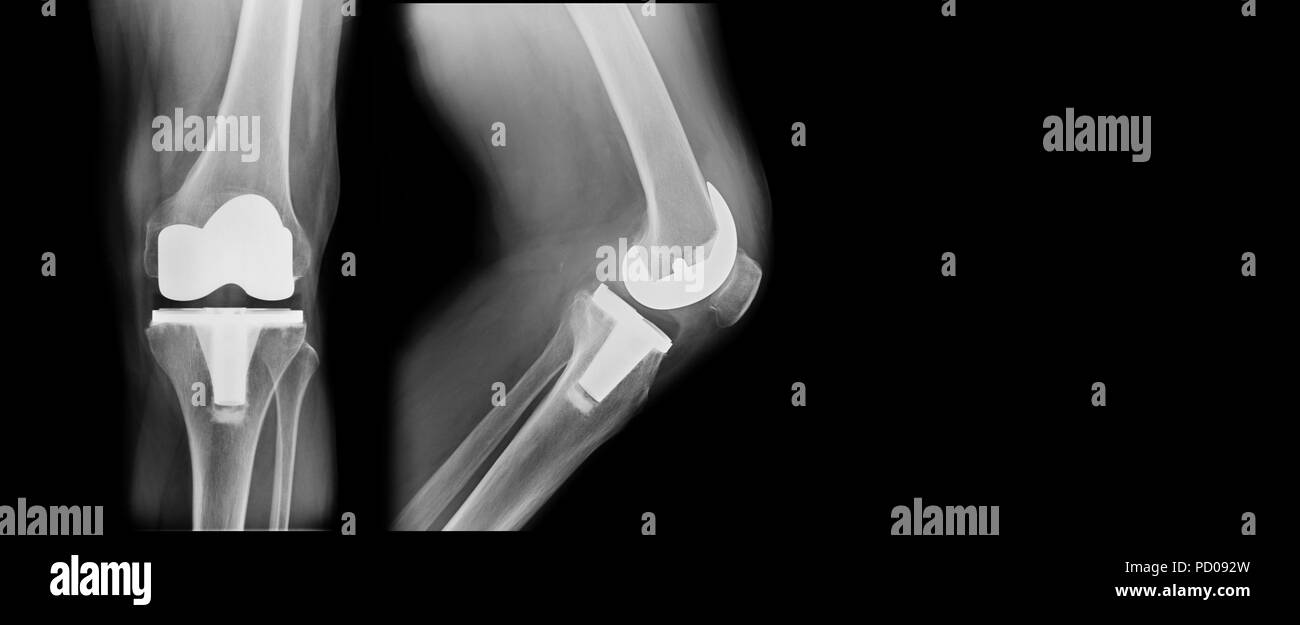 TKA x-ray, la sostituzione totale del ginocchio frontale e vista laterale Foto Stock