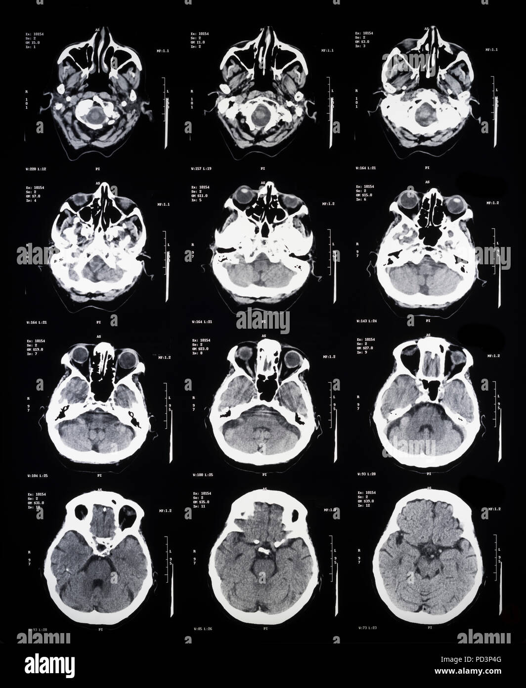 Sequenza di sezioni orizzontali di una femmina di cervello umano, MRI esegue la scansione e il rilevamento di immagini in risonanza magnetica nucleare, Foto Stock