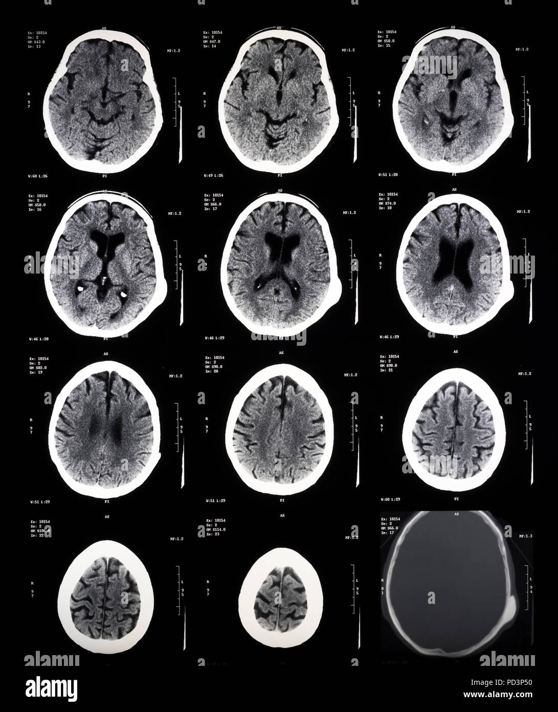 Sequenza di sezioni orizzontali di una femmina di cervello umano, MRI esegue la scansione e il rilevamento di immagini in risonanza magnetica nucleare, Foto Stock