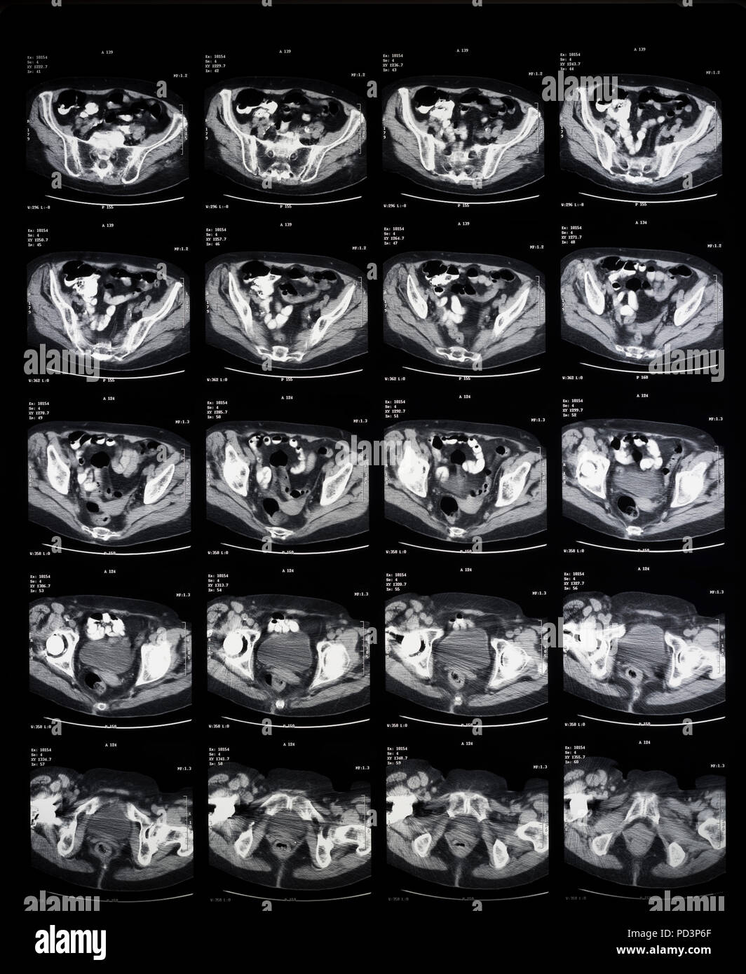 Sequenza di sezioni orizzontali di una femmina di cervello umano, MRI esegue la scansione e il rilevamento di immagini in risonanza magnetica nucleare, Foto Stock