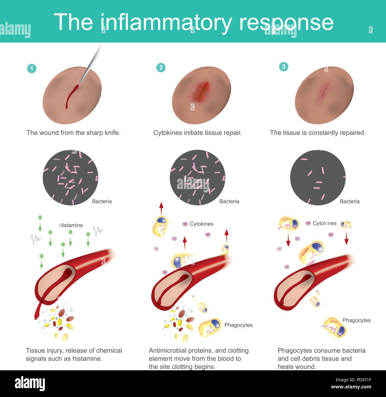 La risposta infiammatoria. Quando il tessuto cutaneo è danneggiato, il corpo si produce immunità, eliminare batteri, insieme con il nuovo tessuto regenerat Illustrazione Vettoriale