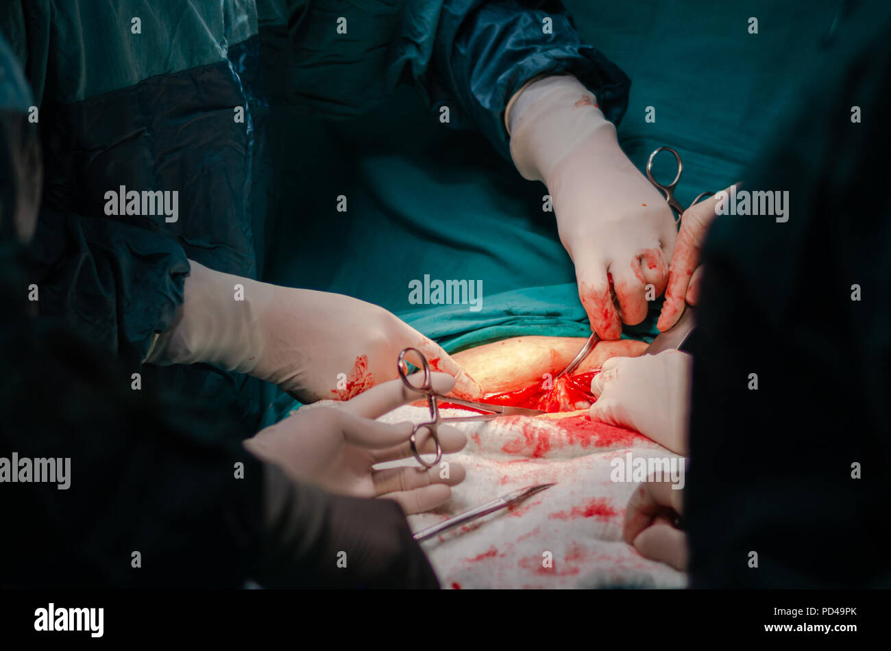 Il dottore taglia il tessuto con il bisturi durante la chirurgia. Foto Stock
