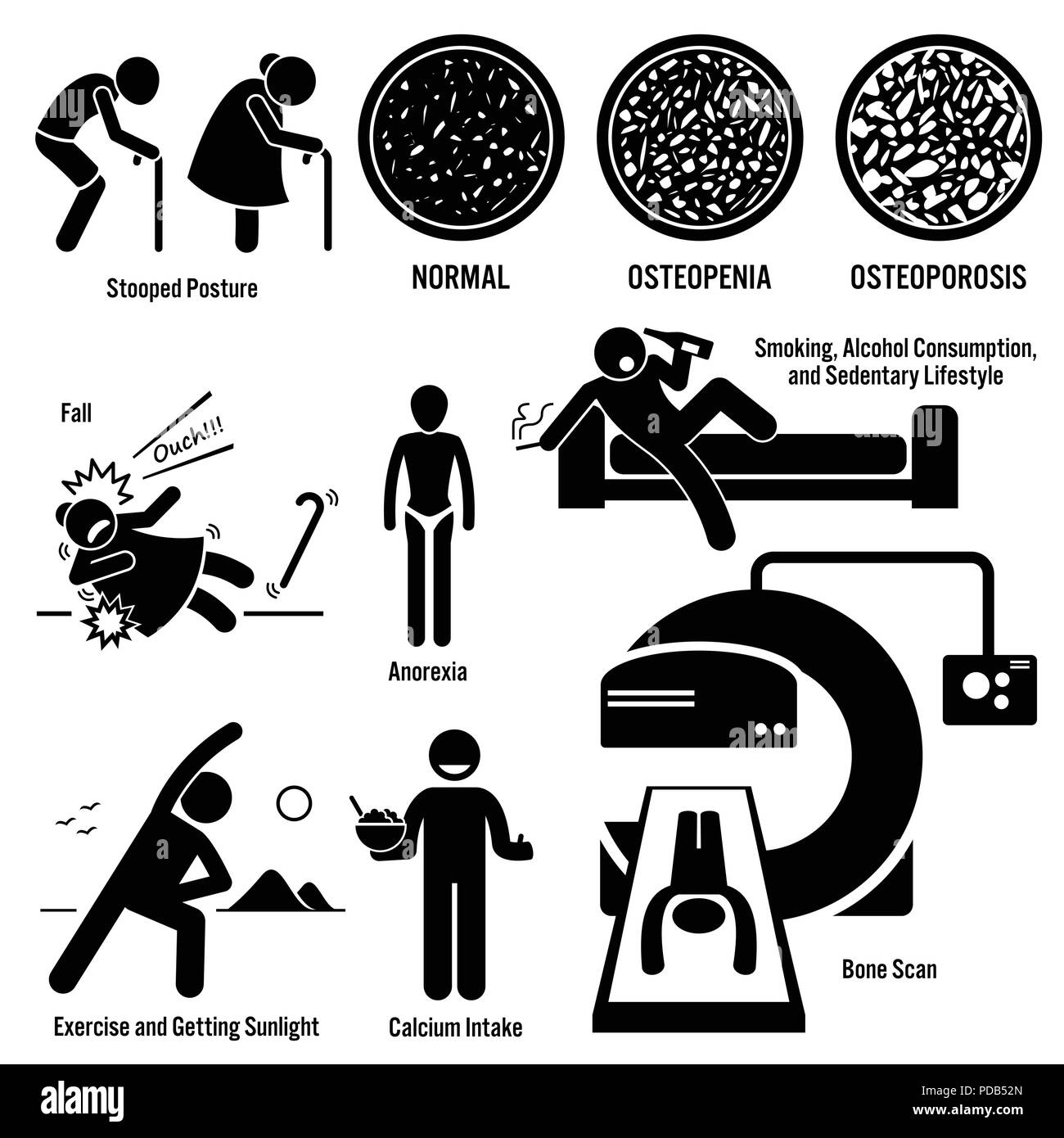 L'Osteoporosi Vecchio Uomo Donna sintomi fattori di rischio diagnosi prevenzione Stick figura il pittogramma icone Illustrazione Vettoriale