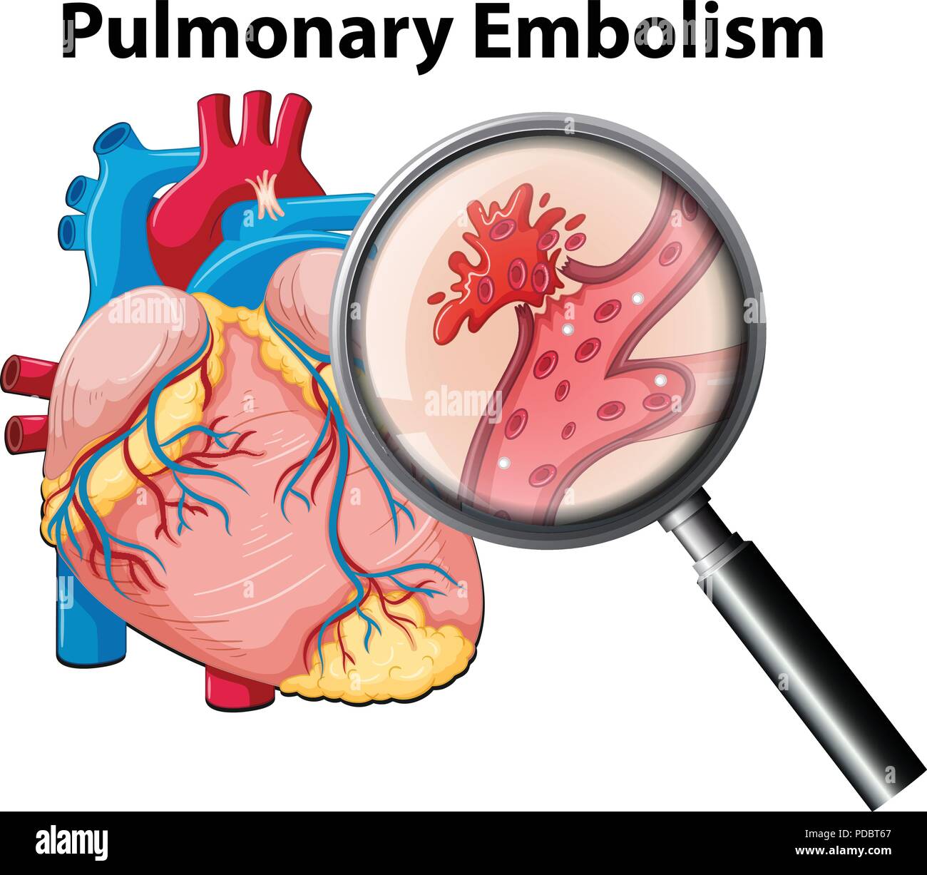 Anutomy umana embolia polmonare illustrazione Illustrazione Vettoriale