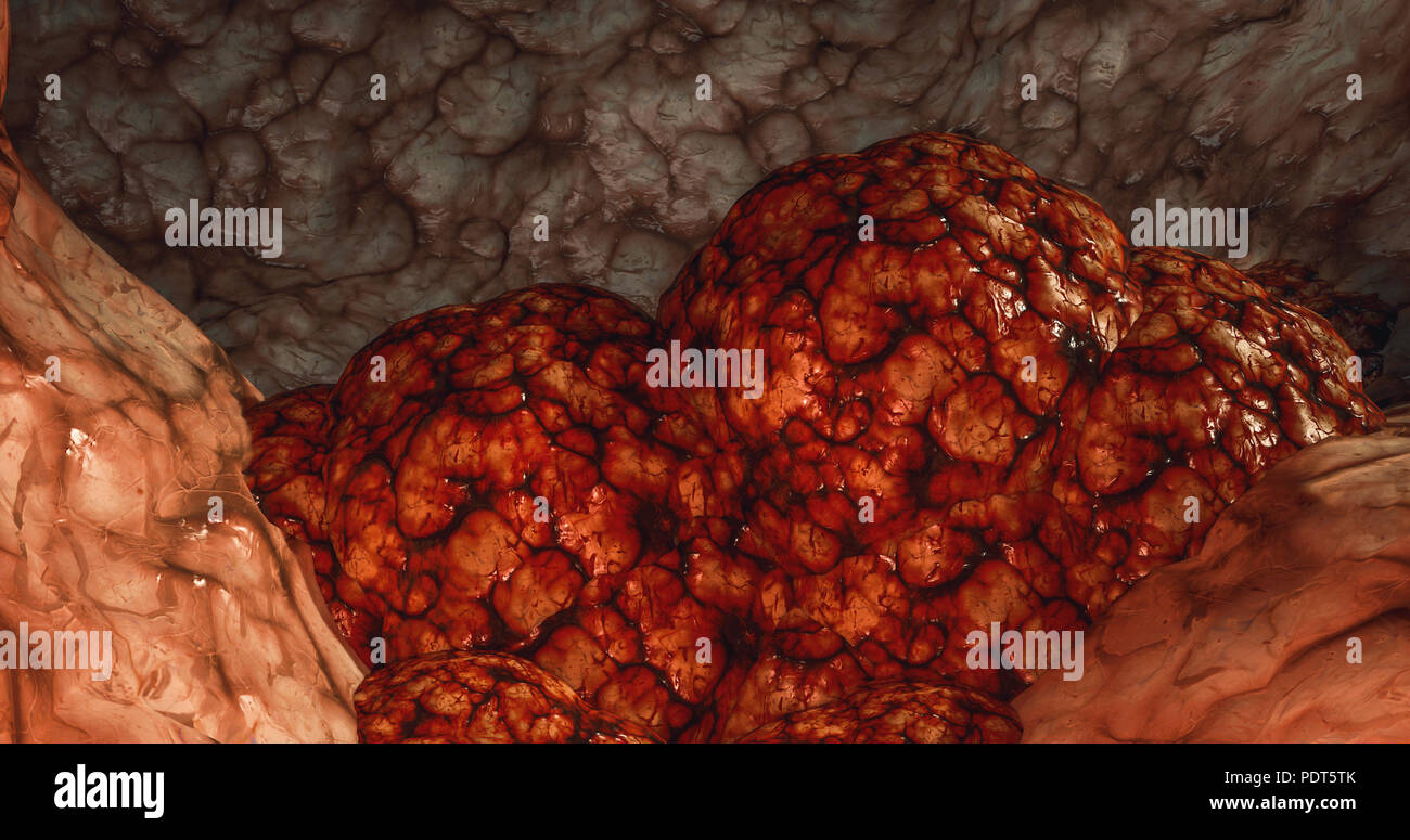 La cellula di cancro Oncologia concetto cancro tumore cisti linfoma di carcinoma colon cancer brest cancri rendering 3D Foto Stock