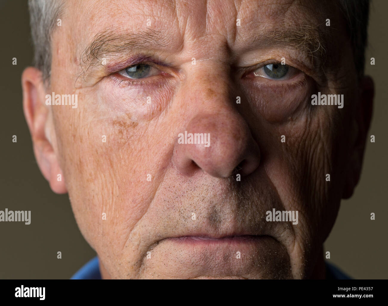 Senior uomo caucasico con un occhio nero Foto Stock