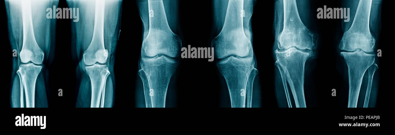 Raccolta ginocchio OA immagine a raggi x Foto Stock