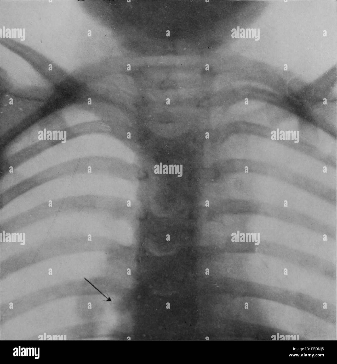 In bianco e nero a raggi X del quattro-anno-vecchia ragazza dello sterno, con una freccia per indicare la posizione di una bambola braccio Cina presentate nel suo polmone, 1910. La cortesia Internet Archive. () Foto Stock