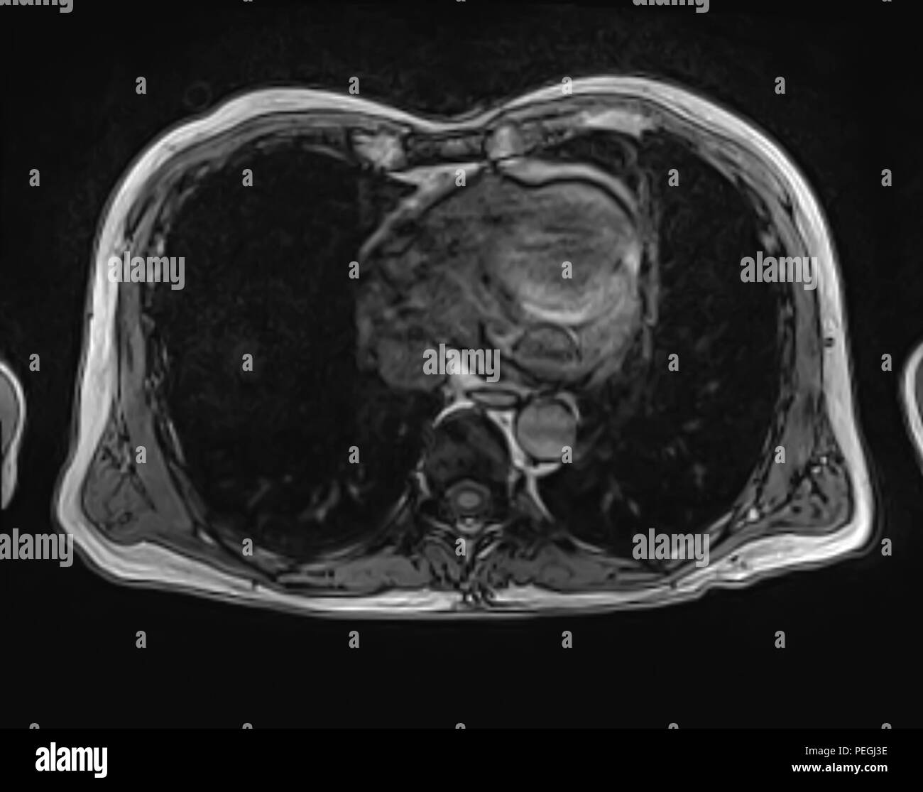Sezione trasversale addome MRI scan di 60 anno vecchio paziente di sesso maschile. Questo paziente soffre di una pietra di rene Foto Stock