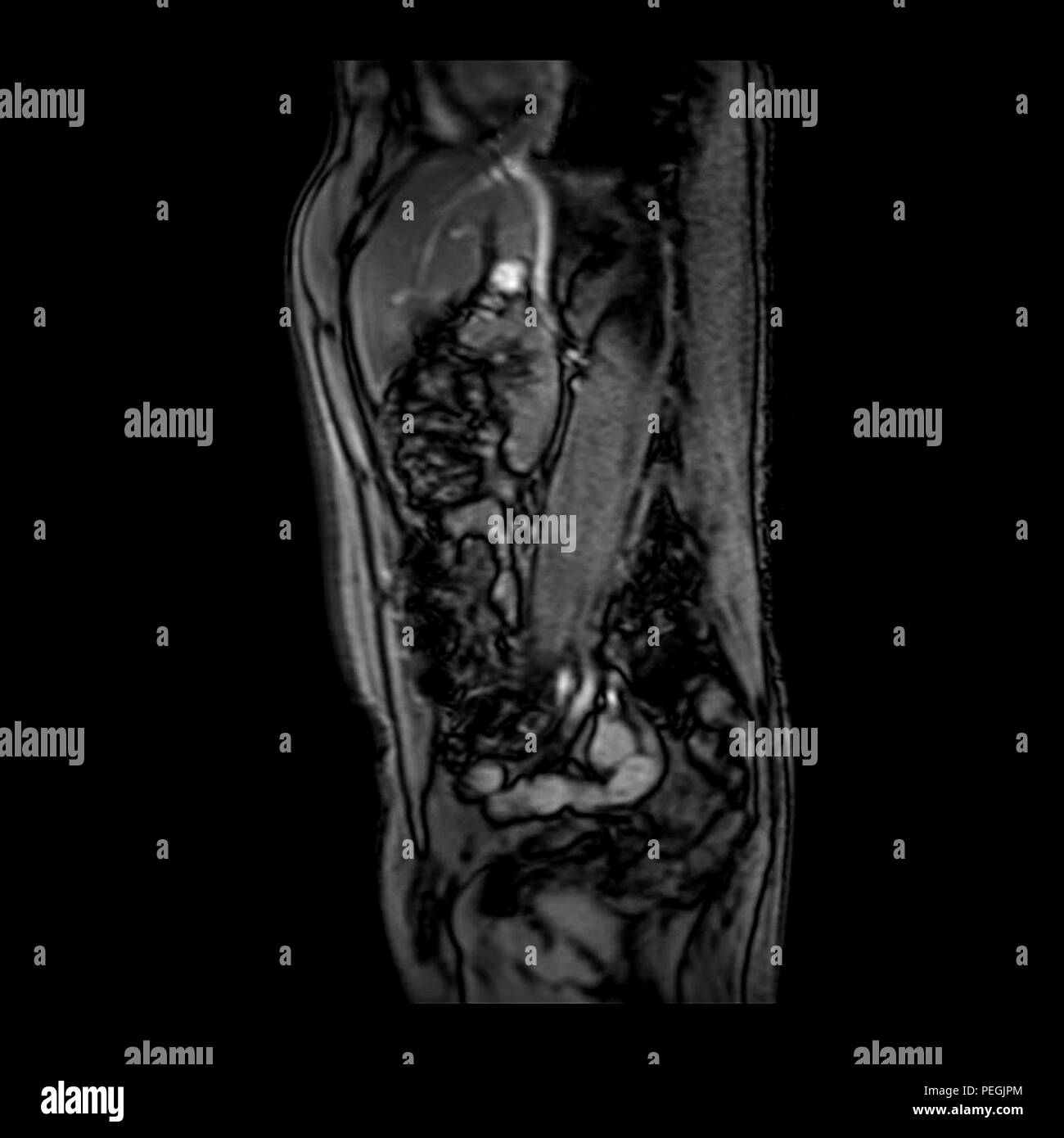 Vista laterale addome MRI scan di 60 anno vecchio paziente di sesso maschile. Questo paziente soffre di una pietra di rene Foto Stock