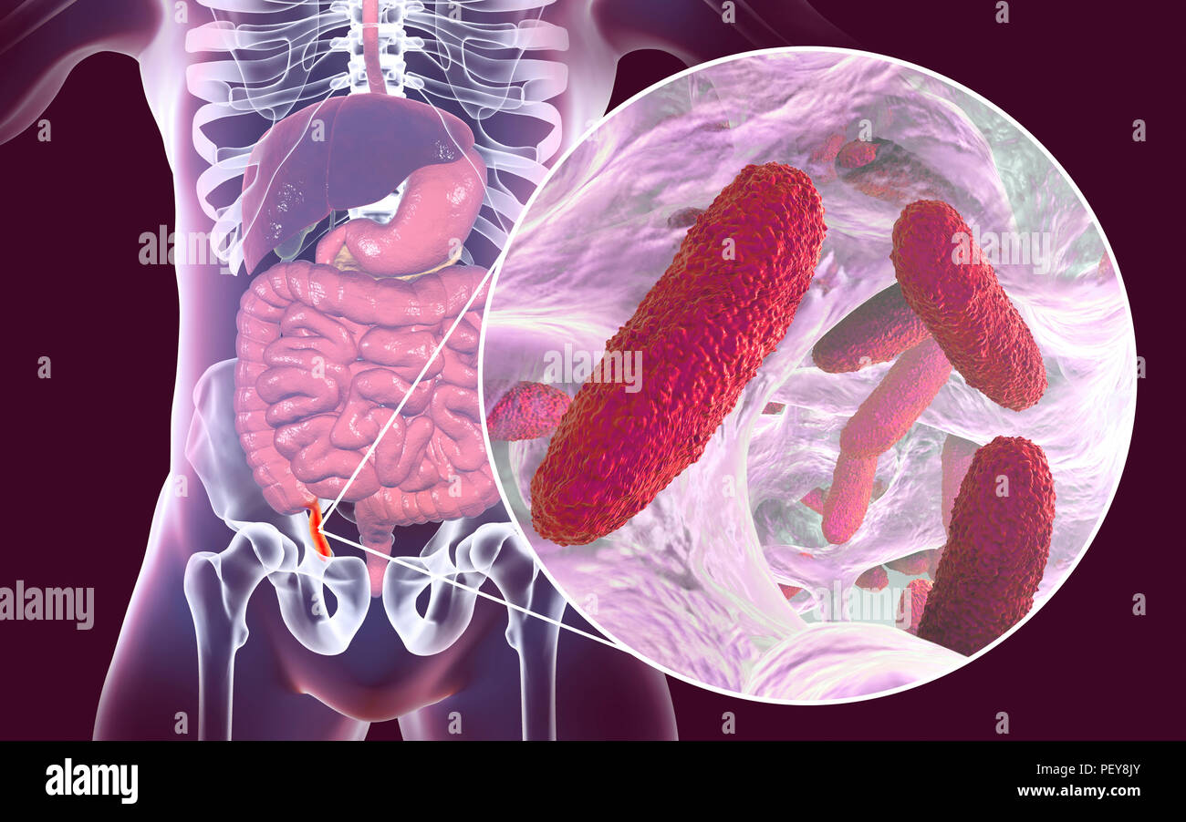 Appendicite. Illustrazione di un uomo in appendice, che lo mostra in rosso e infiammato di appendicite e una vista ravvicinata di batteri, gli agenti causativi di appendicite. A forma di asta batterio Klebsiella pneumoniae è uno degli agenti causali di malattie acute e croniche appendicite. Foto Stock