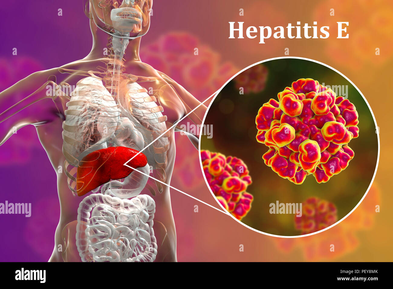 Epatite e infezione. Computer illustrazione che mostra il fegato e una vista ravvicinata di epatite e virus. Foto Stock