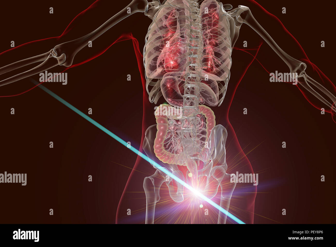 Il trattamento laser di emorroidi, concettuale illustrazione del computer.  Vista posteriore del corpo umano con le emorroidi esterne nell'ano e la  rimozione di emorroidi da chirurgia laser Foto stock - Alamy