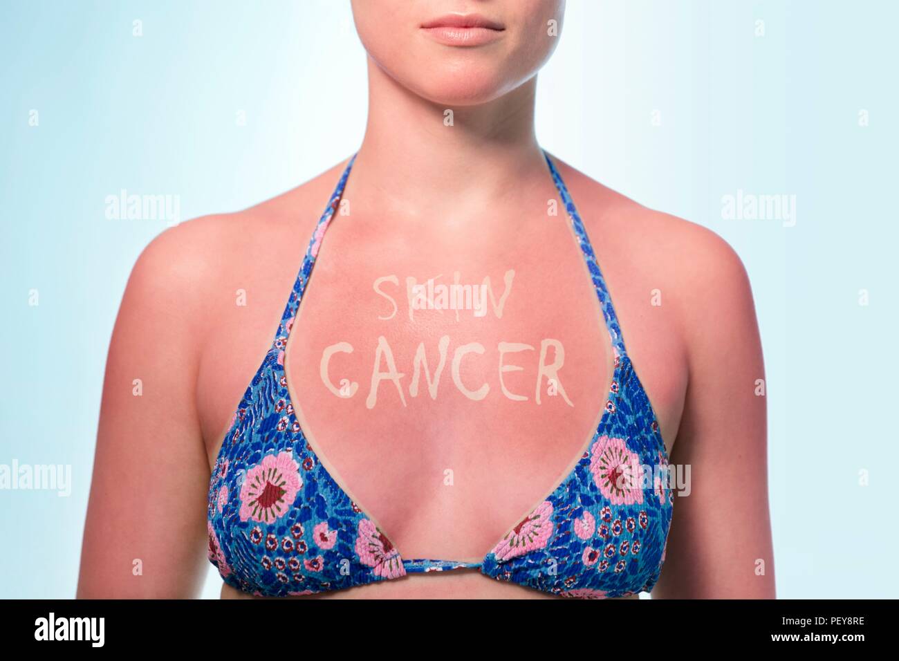 Il cancro della pelle dai danni solari immagine concettuale. Donna con 'skin il cancro" scritto sul suo petto bruciata dal sole. Foto Stock