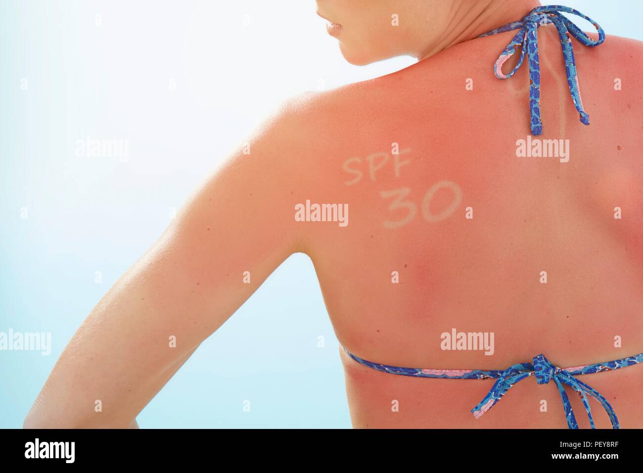 Donna con la schiena bruciata dal sole e 'SPF 30' scritta sulla sua spalla. Foto Stock