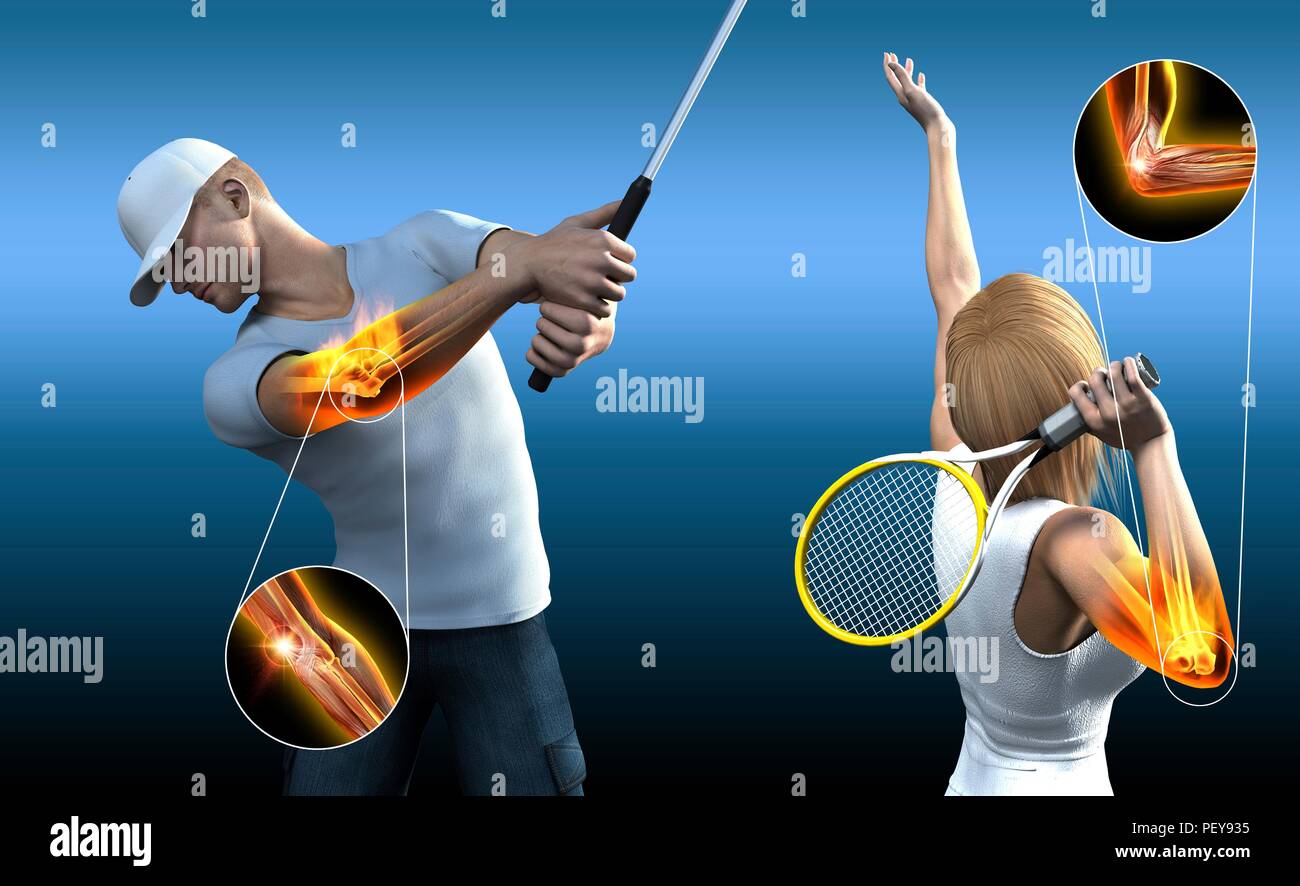 Sport lesioni a gomito, illustrazione del computer. Foto Stock