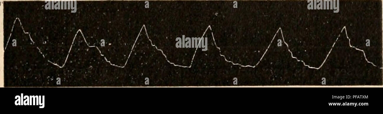. Dictionnaire de physiologie. Fisiologia. Ã¯i"iG. 83. Â AccÃ©lÃ©razione des battements du cieur d'onu cheval sous l'influenza ds l'hÃ©morrao-ie. Â 1, Pouls normale; 2, l'animale est couchÃ©; 3, HÃ©morragie de 5 litri; 4, Nouvelle hÃ©morragie fare 5 litri; F&GT;, }IÃ©niorragie de 5 litri; 6, HÃ©morragie de 2 litri; 7, HÃ©morragie de 2 litri, d'aprÃ¨s Marey. sur le cÅur une action directe. Mais il ne tarda pas Ã reconnaÃ®tre avec Ber.xstein que. FiG. 84. Â Marev, la circolazione du sang. Radiale Pouls avant une hÃ©morragie, d'aprÃ¨s Lorain ' t 1 A, C ^ l' i S5. Â Pouls ia radiale)r('S une liÃ© Foto Stock