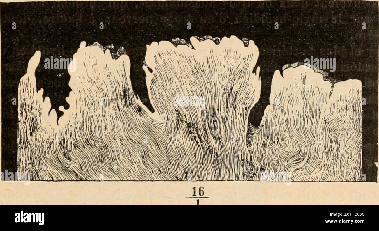 . Dictionnaire de physiologie. Fisiologia. La gotta. 579 vation marquée du derme muqueux, Pí©nélralion de Ijouquels vasculaires Cà l'intérieur ; épaisse assise épilhéliale enveloppante, de la superficie de laquelle s'échappe bouquet onu plus ou moins riche de prolongements filiformes, en nombre variabile (généralement de 15 à 20). Parfois ces prolongements filiformes sont retournés à l'intérieur de la papille comme des festons rentrés <à l'intérieur d'une manche; d'autres fois ils font déanomalia, et la papille se réduit à une surélévation cylindrique ou conique, présentant à sa surfac Foto Stock