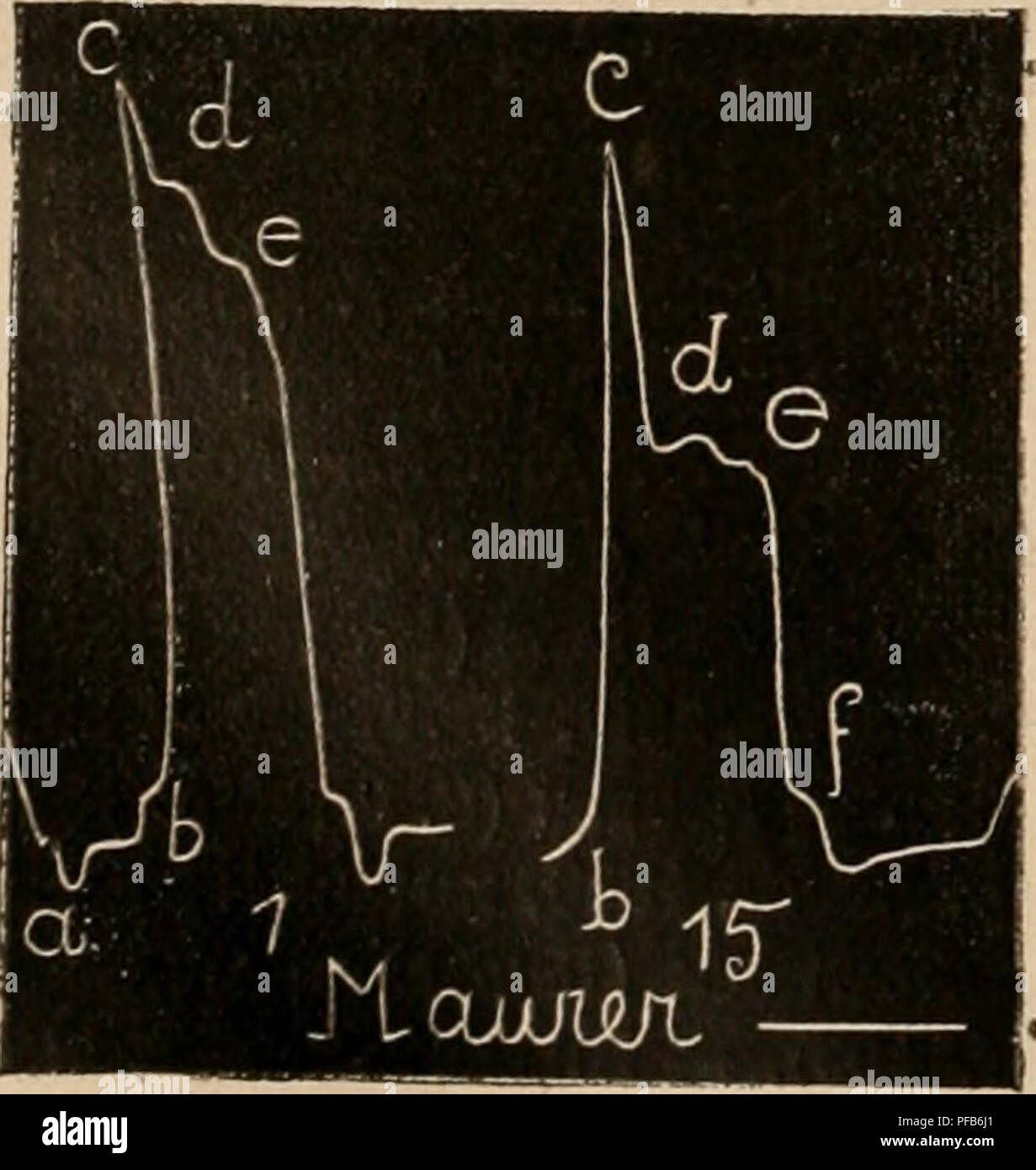 . Dictionnaire de physiologie. Fisiologia. FiG. 2U, âTracÃ©s du clioc du cÅur (Landois) Si les auteurs s'accordent plus ou moins sur la forme gÃ©nÃ©rale du cardiogramme typique de l'homme, il n'en est pas de mÃªme de son interprÃ©tazione. Marey et Chal- vitello, auscultant le cÅur du Cheval, notaient au moyen d'informazione delle Nazioni Unite Ã©lec- trique le moment oÃ¹ ils entendaient le seconda bruit du cÅur (clÃ'ture des sigmoÃ¯des) ; momento ce corres- pondait à la ligne de descente cf du tracÃ© cardiogra- ]&GT;hique et marquait donc la (in de la sistole. Landois una CRU, au contraire, se convaincre que le seconda bruit Foto Stock