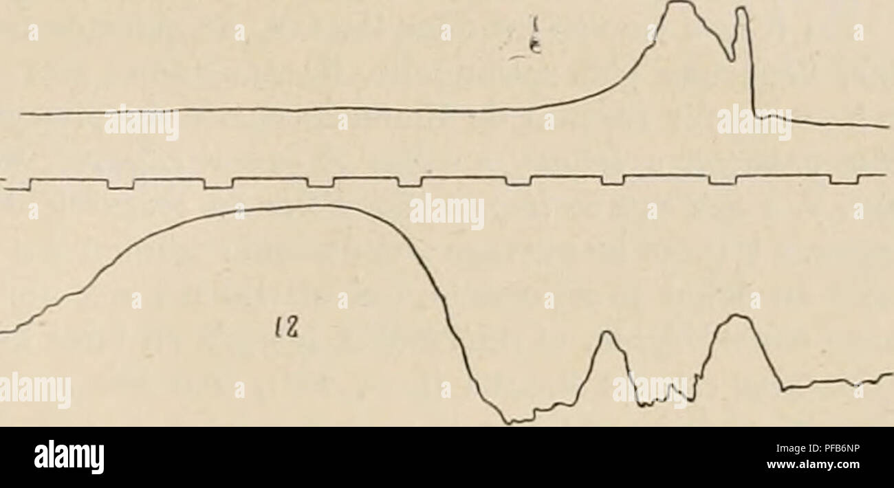 . Dictionnaire de physiologie. Fisiologia. La deglutizione. 735. FiG. 89. Â7. Dt'glutition d'une massa semi-liquide. Le tracÃ© supÃ©- rieur provient du pliarynx, l'infÃ©rieur est obtenu au moyen d'onu ballon enfoncÃ© Ã 12 centimÃ¨tres. La deuxiÃ¨me Ã©lÃ©vation provient de restes alimentaires renvoyÃ©s par le faringe. est imputabili Ã l'azione des constricteurs du pliarynx. Ce mode de progression du bol appartient aussi aux dÃ©glutitions isolÃ©es; mais il est incomparablement plus accusÃ© dans les dÃ©glutitions associÃ©es. Â" (p. 2o2) Arloing croit donc que la preniitre Ã©lÃ©vation du tracÃ© que nous Foto Stock