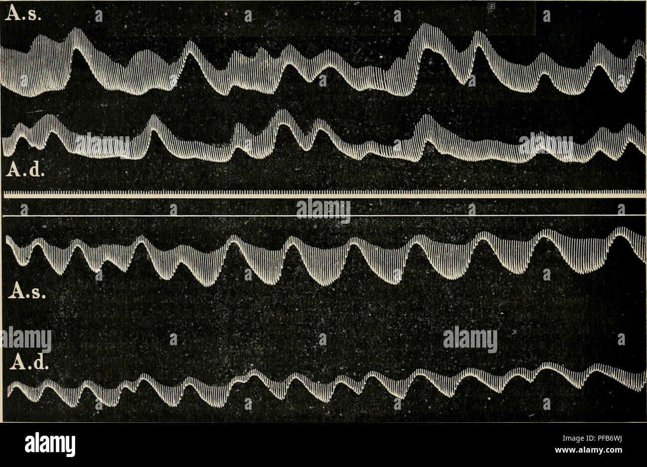 . Dictionnaire de physiologie. Fisiologia. 198 CÅUR. devenir un bout d'onu assez long temps beaucoup plus faibles'et disparaÃ®tre finalement tout Ã fait . Fano les un enregistrÃ©es pendant des journÃ©es entiÃ¨res sans interruzione, au moyen d'onu appareil spÃ©cial (jusqu'à treize jours). Â 3Â° Dans quelques cas on peut observer une disparition totale du rythme fondamental, tandis que les oscillazioni de tonicitÃ© continuent. Le contraire peut aussi se prÃ©senter. Il est donc Ã©vident que les pí©riodes du tonus et la funzione fondamentale sont indÃ©pen- dantes les unes de l'autre. Â 4Â° Si les co Foto Stock