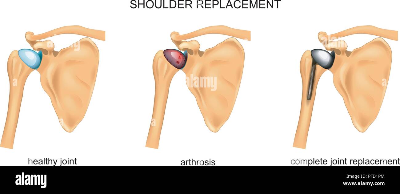 Illustrazione vettoriale di sostituzione della spalla. chirurgia. traumatologia Illustrazione Vettoriale