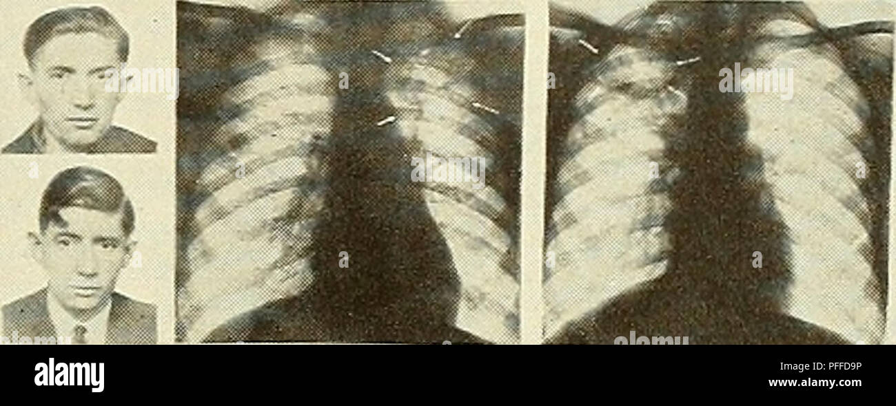 . Un decennio di progressi nell'eugenetica; documenti scientifici del terzo congresso internazionale di eugenetica, tenutosi presso il Museo Americano di Storia Naturale di New York, Agosto 21-23, 1932 ... Comitato di pubblicazione, Harry F. Perkins, presidente ... Harry H. Laughlin, segretario. Eugenetica. EINEIIGE ZWILIINGE-SEIT 91AHREN GETRENNT 05TPREUSSEN -BERLIN ERKRANKUNS GLÂ£ICKZE!TI6 -tCPROZESS SEHR AHNLICH + MONOZYGOTIC TWlNS-llVINSAfART DA OGNI ALTRA CA-Â"i 9^^Â"K in .v ostmici aKaMiicsmim aotviiin â jjHrcuis.s FN LO STESSO MESE E NELLA STESSA MANNEP. EINEIISE ZWialNSE -MEWANIPCER IN BEBIIN 91AHK GETBENNT-tUN6BÂ Foto Stock