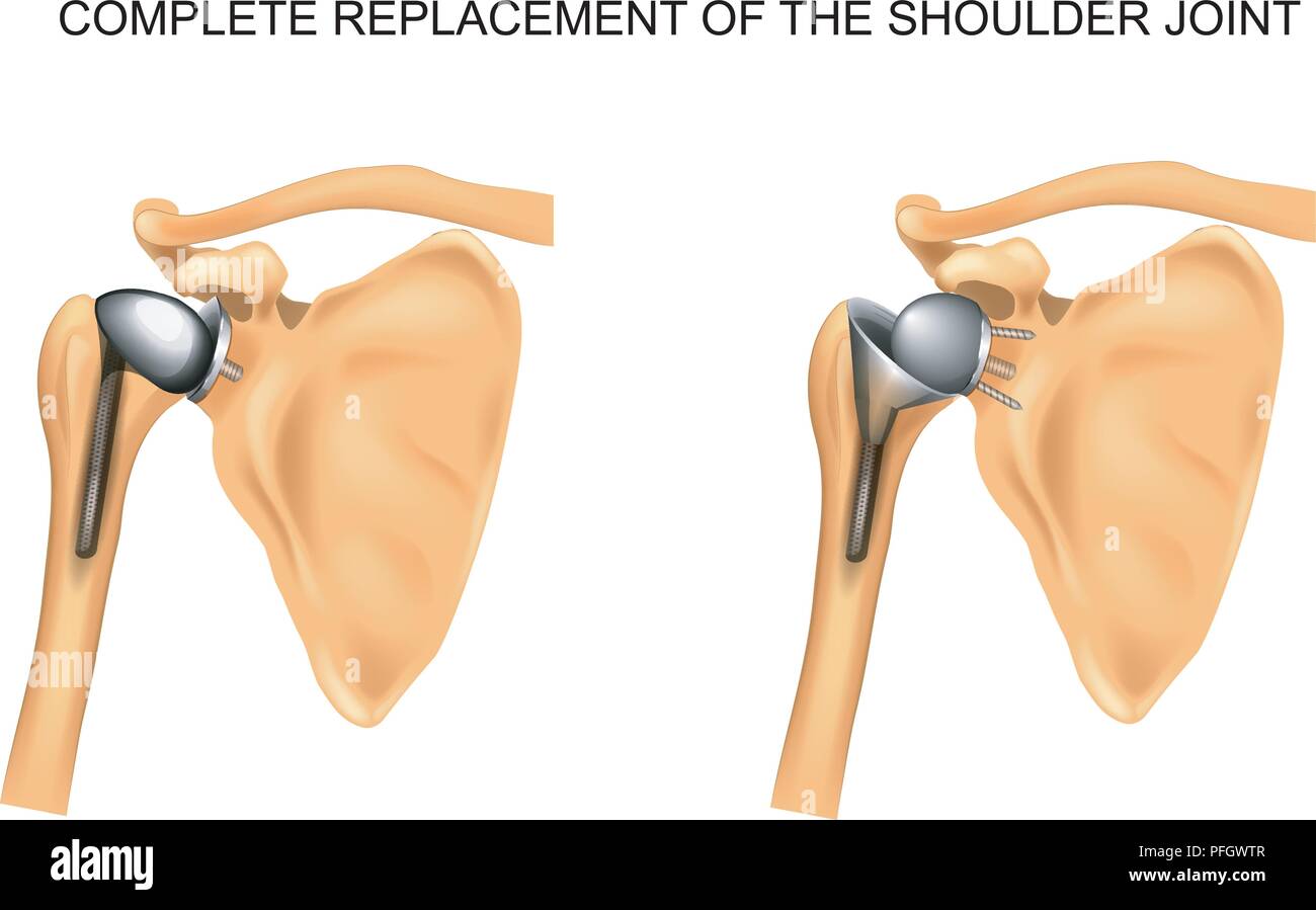 Illustrazione Vettoriale dei tipi di protesi di spalla Illustrazione Vettoriale