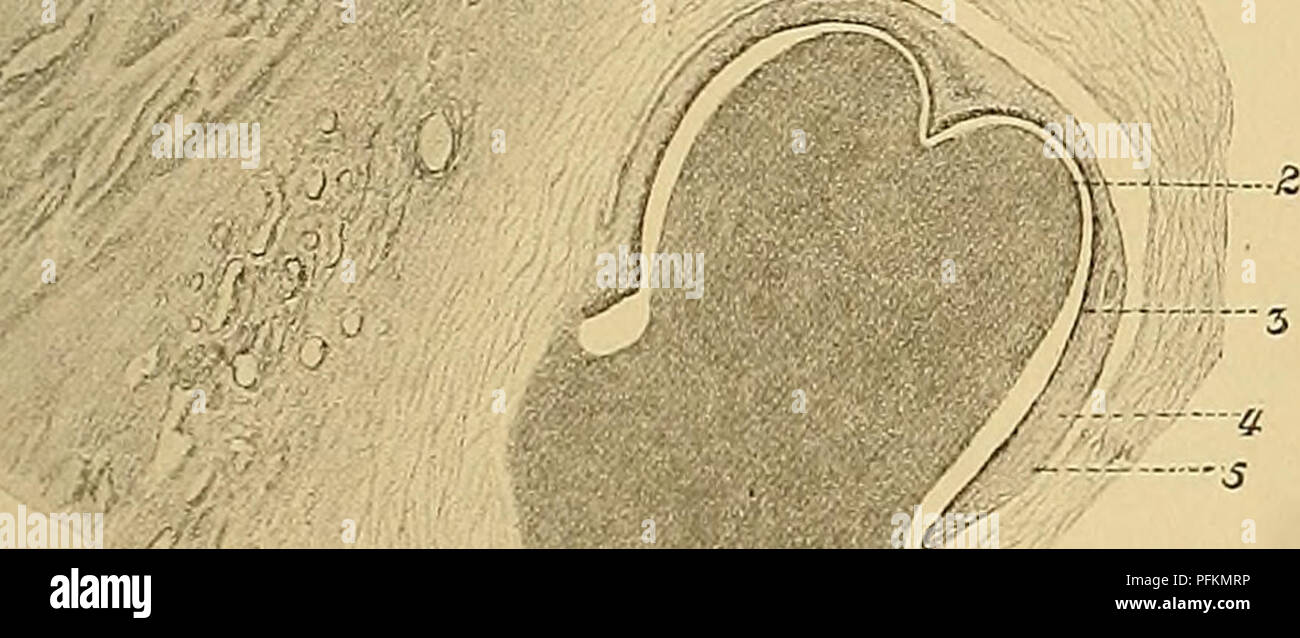 . Denkschriften der Medicinisch-Naturwissenschaftlichen Gesellschaft zu Jena. . "1 ;y &gt;&gt;-?'' H^^.;'^-*'"^" Fig. 71. Fig. 72. Fig. 71. Längsschnitt durch die Stosszahnanlage Narwalembryos eines von 25,7 cm. Länge. Vergr. 33. Ho Zahnpapille. 2 Odontoblastenschicht. 3 inneres Schmelzepithel. 4 Schmelzpulpa. 5 äusseres Schmelz- epithel. Fig. 72. Hinter der Stosszahnanlage liegende Zahn- anlage aus dem Oberkiefer Narwalembryos eines von 25,7 cm. Rückenlänge. Vergr. 33. Längsschnitt. Für die Auffassung des Stosszahnes vom Narwal scheint mir die Thatsache embryologische von hohem Foto Stock