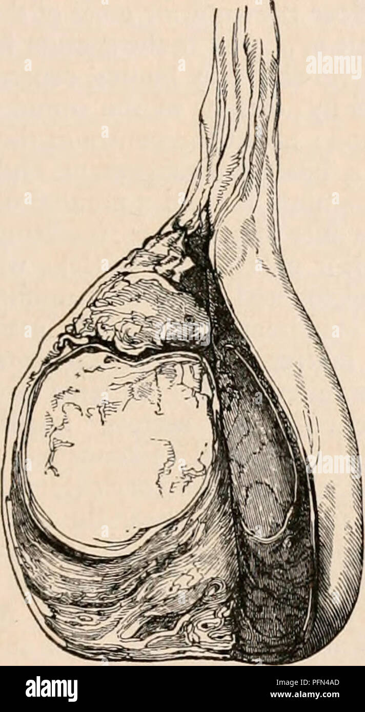 . Il encyclopaedia - Wikizionario di anatomia e fisiologia. Anatomia e fisiologia; Zoologia. Testicolo (Anatomia anormale). come grezzo deposito tubercolare; ma su un ulteriore esame sarà trovato per essere contenuta in una distinta cisti, dal quale esso può essere facilmente separato e la struttura del testicolo sarà percepito per essere più o meno alterata dal suo stato sano; considerando che nella malattia tubercolare, il deposito morboso è in contatto immediato con la struttura tubolare, che pur atrophied mediante pressione, è di solito in altri aspetti del suono. Pus di calcestruzzo può allo stesso modo essere scambiato per la ditta tappeto giallo- ter ef Foto Stock