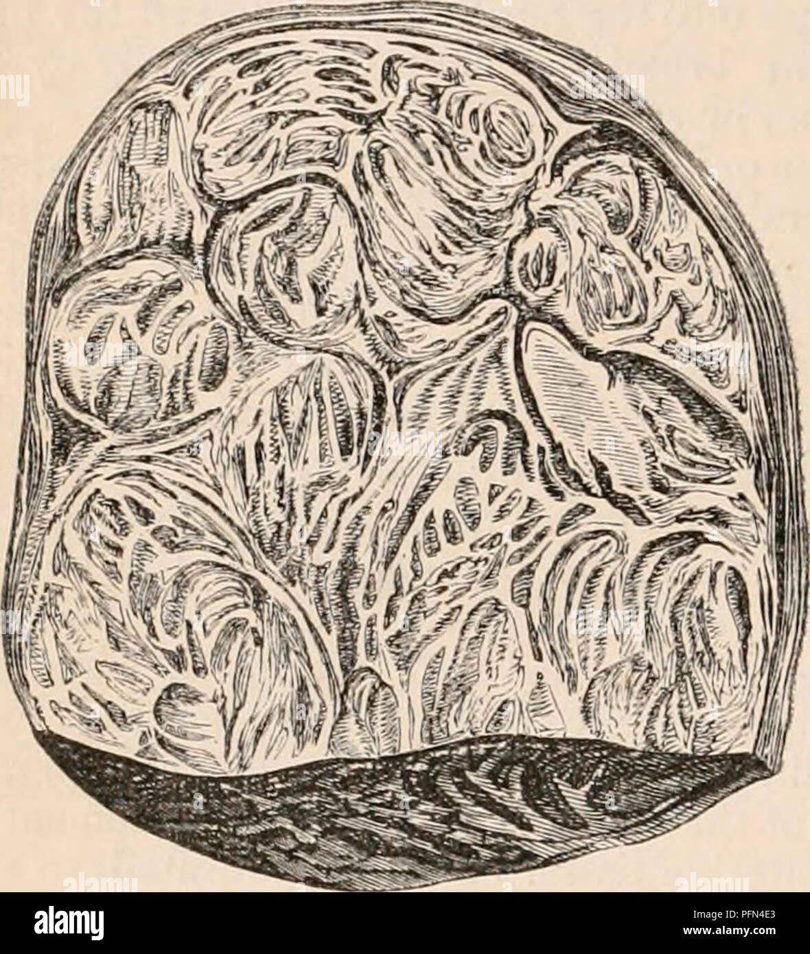 . Il encyclopaedia - Wikizionario di anatomia e fisiologia. Anatomia e fisiologia; Zoologia. 690 utero e le sue appendici. massa, in modo tale che un muscolo piuttosto che un materiale fibroso può essere facilmente staccato e ruotata al di fuori del tessuto determina. Una piccola quantità di clastico investendo la sua capsula (/%. 475 ). fibra è anche occasionalmente trovati in questi ute- rine formazioni. Fig. 475. Fig. 474-.. La sezione di tumore fibroide uterino. (Annuncio Nat.) Le variazioni strutturali osservabili in leiomioma dell'utero, dipendono principalmente sulle peculiarità nella disposizione di tali elementi componenti. In più denso di formazioni, il whi Foto Stock