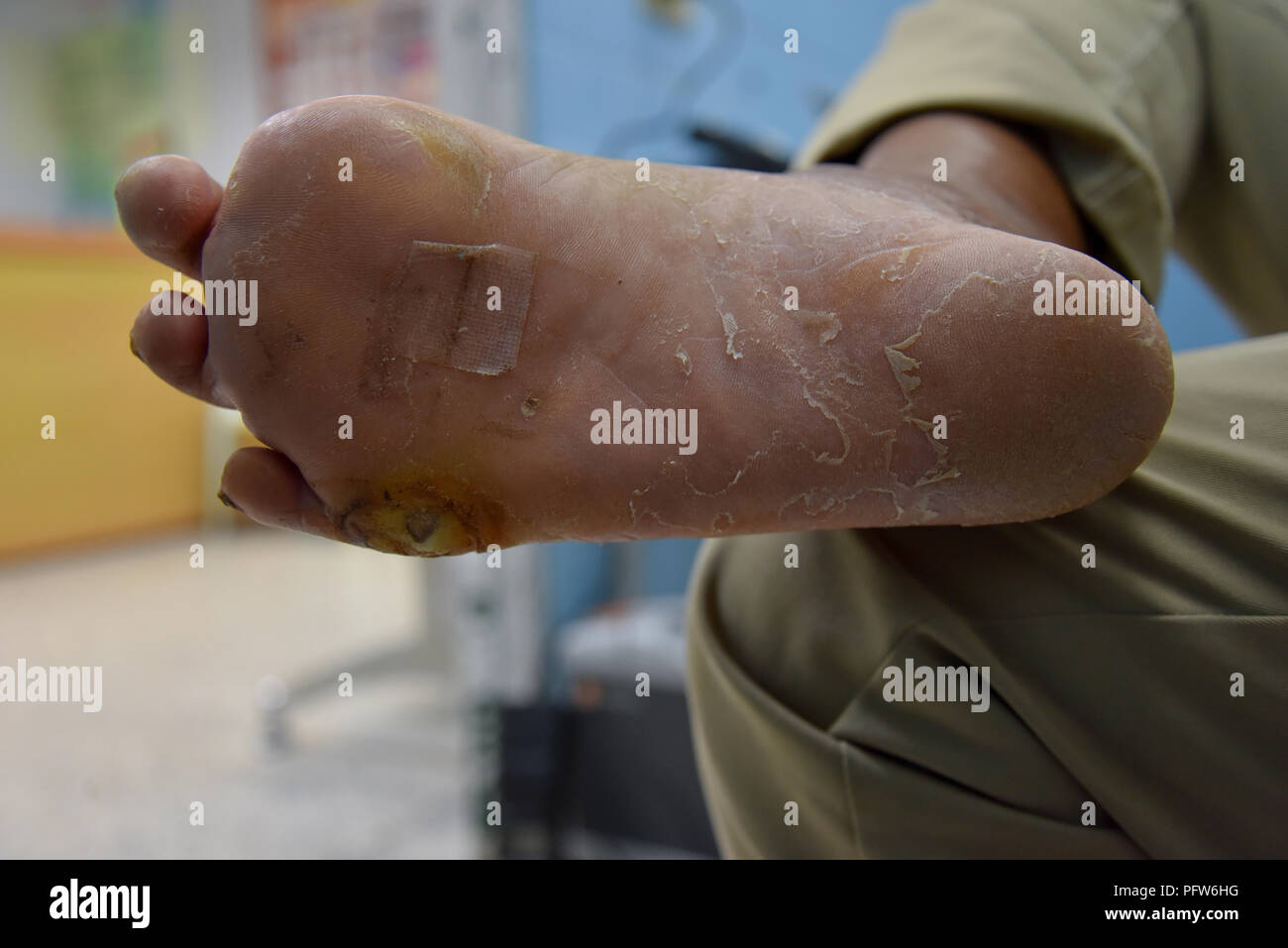 Il diabete piede, ferita infettato il diabete al piede del paziente del diabete Foto Stock