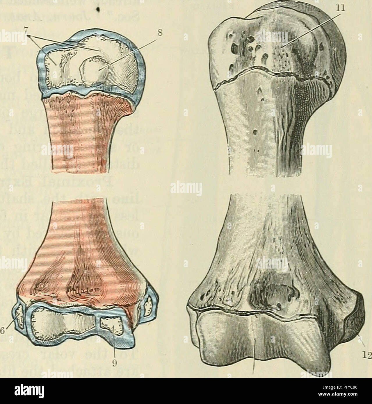 . Cunningham il libro di testo di anatomia. Anatomia. Al momento della nascita. Circa 5 anni. Fig. 201. Circa dodici anni. -L'ossificazione dell'omero. Circa 16 anni. 8. Centro per il tubercolo minore fusibili con altri centri di circa 7 anni. 9. Appare circa 11 o 12 anni. 10. Epifisi inferiore i fusibili con l'albero di circa da 16 a 17 anni. 11. Epifisi superiore i fusibili con l'albero di circa 25 anni. 12. I fusibili con l'albero di circa 17 a 18 anni. 1. Appare precocemente nel secondo mese di vita fcetal. 2. Per i più grandi il tubercolo, compare da 2 a 3 anni. 3. Per la testa, compare entro i primi 6 mesi. 4. Per epicondyle mediale, appare circa 5 anni. 5. Per c Foto Stock