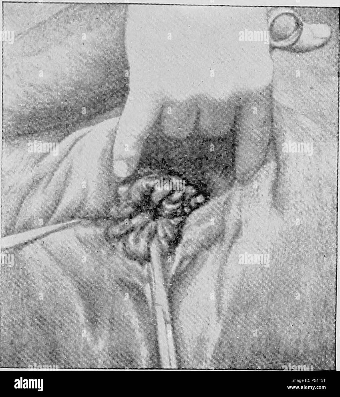 . La sterilità di vacche, le sue cause e il trattamento. Infertilità in animali; vacche. 37 lato era un affitto con pareti lisce, che era 3*/2 pollici di lunghezza e raggiunta entro circa un pollice del os uteri in- ternum. Il canale cervicale era ampia e aperta, e solo un po' più stretta sulla sua estremità interna. Vi era un abbondante purulento, di scarico e la parete uterina è stato coinvolto. Durante l'estate 1907 di degenerazione cistica delle ovaie, e la vacca non è in stato di gravidanza. Fig. 8-'mucca da Myregaard. A volte bande di tessuto connettivo sono soddisfatte con; essi possono riguardare l'intero portio e crescere da Foto Stock