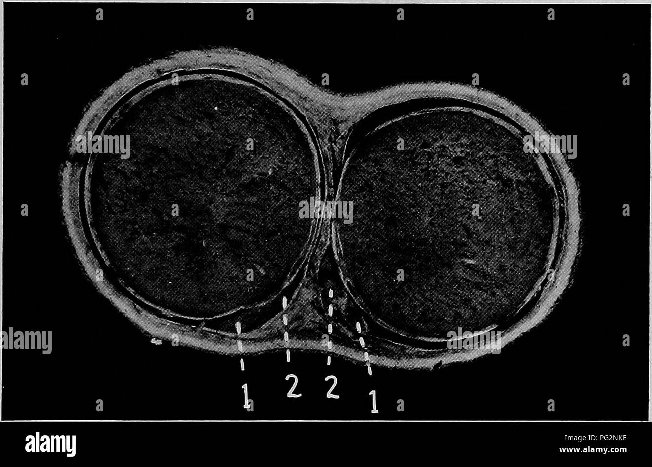 . Le malattie degli organi genitali degli animali domestici. Medicina veterinaria. Il maschio di organi genitali esterni 7 corpo di epididimo sono pertanto solo vagamente attaccata al testicolo e queste permettono, in alcune circostanze, di ampia separazione dal premistoppa. Così in cryptorchidy nel cavallo, il gubernaculum, come mostrato in Fig. 1, attraversa la coda di epididimo ed è strettamente collegato ad esso. In immettere- ing l'anello inguinale, la coda di epididimo, con il gubernaculum, deve condurre e fisiologicamente la coda del testicolo deve accompagnarla. Ma a volte l'estremità caudale del testicolo essere Foto Stock