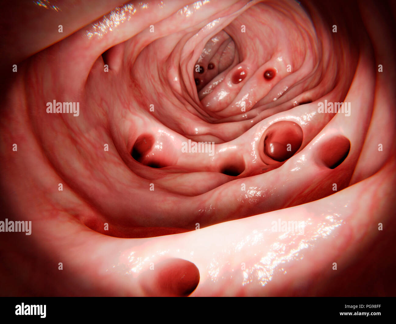 Diverticolosi nell intestino crasso, illustrazione. Diverticolosi provoca sacs (diverticoli, mostrato qui) per formare e sporgenti esternamente dalla parete del colon (Intestino crasso). Questi possono diventare infiammata, infettati e può rompersi (diverticolite). Trattamento richiede farmaci antibiotici. I casi più gravi possono richiedere un intervento chirurgico per rimuovere parte del colon. Foto Stock