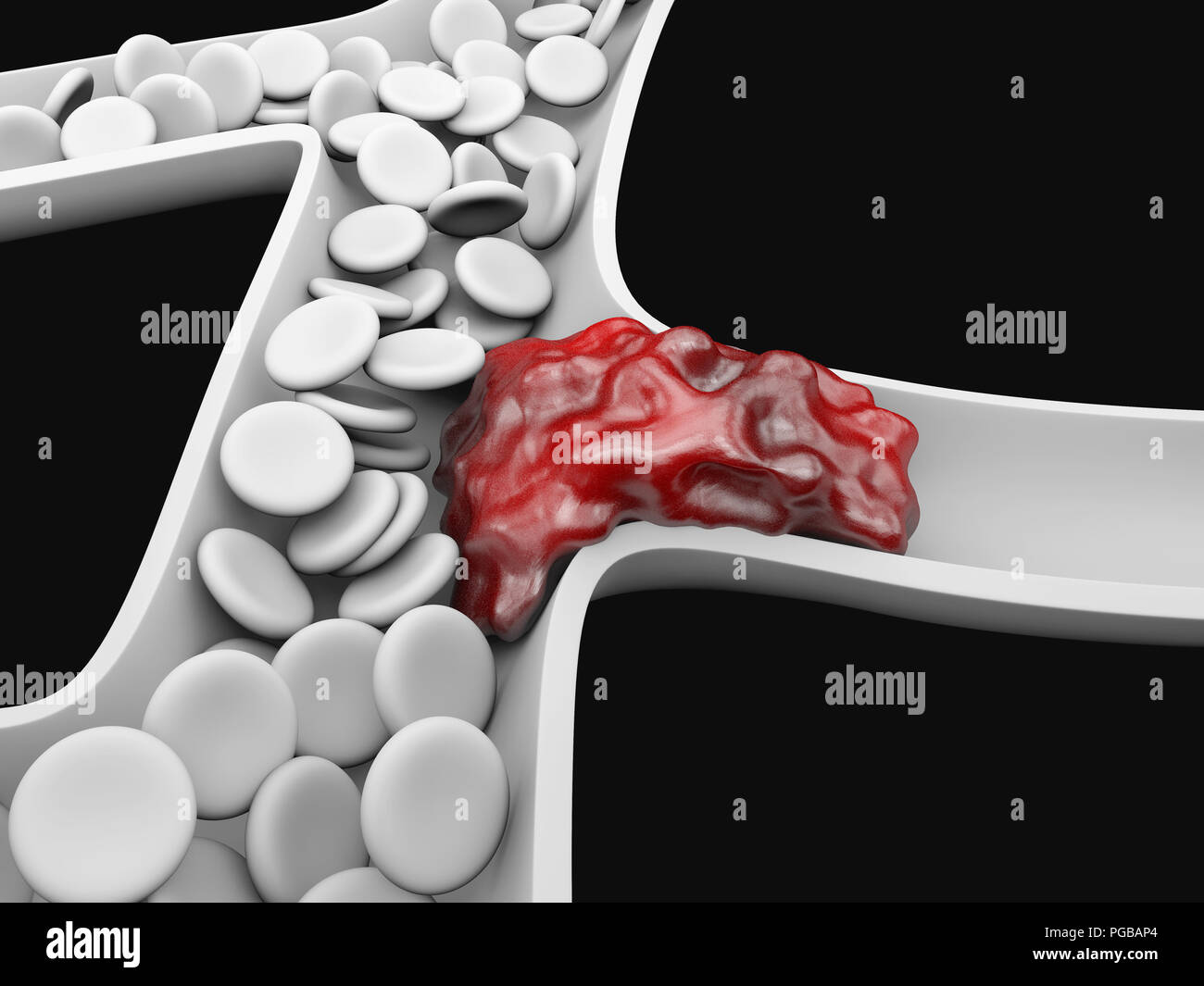 La trombosi venosa profonda o coaguli di sangue. L'embolia Foto Stock