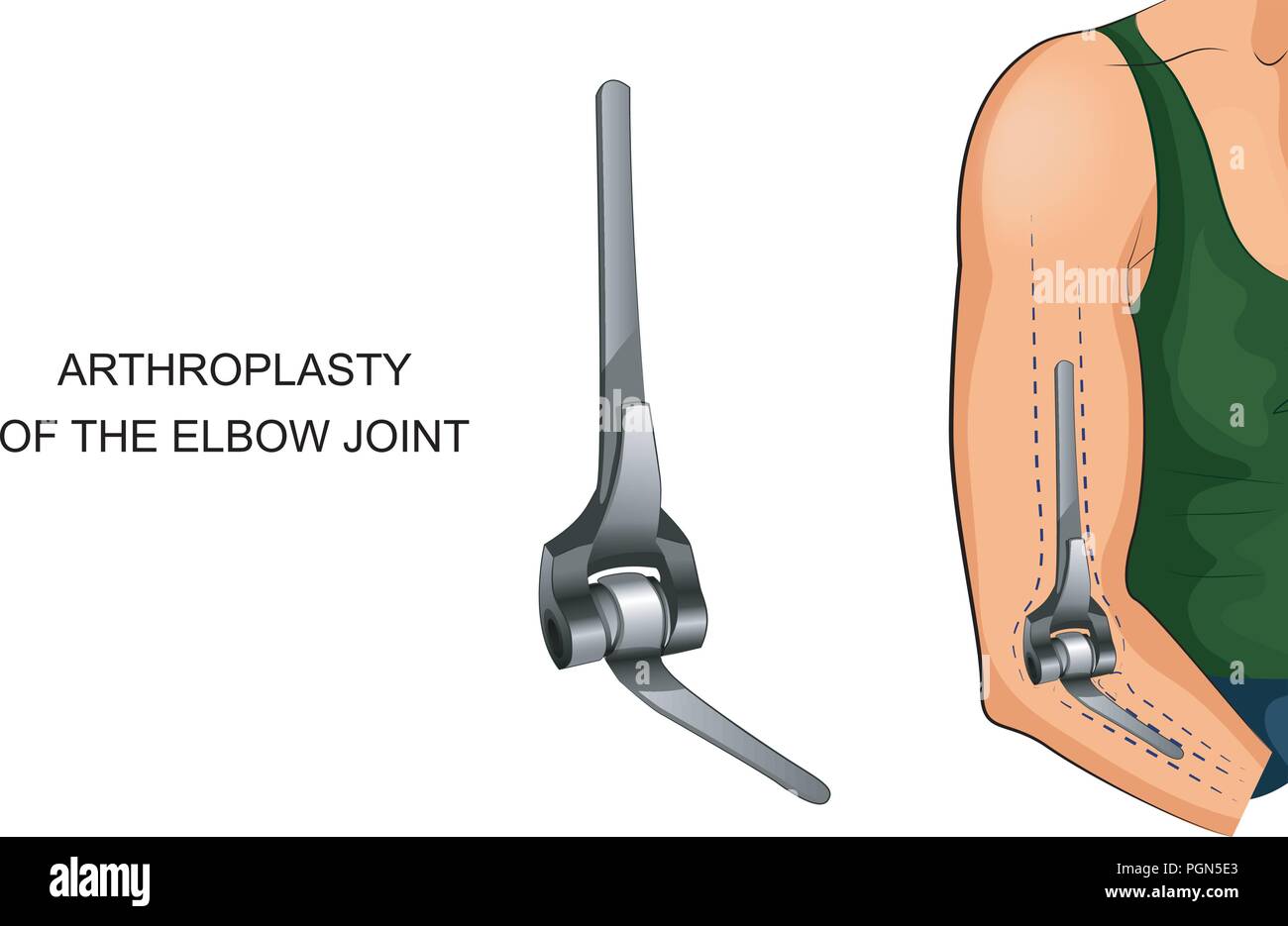 Illustrazione vettoriale della endoprotesi del giunto a gomito Illustrazione Vettoriale