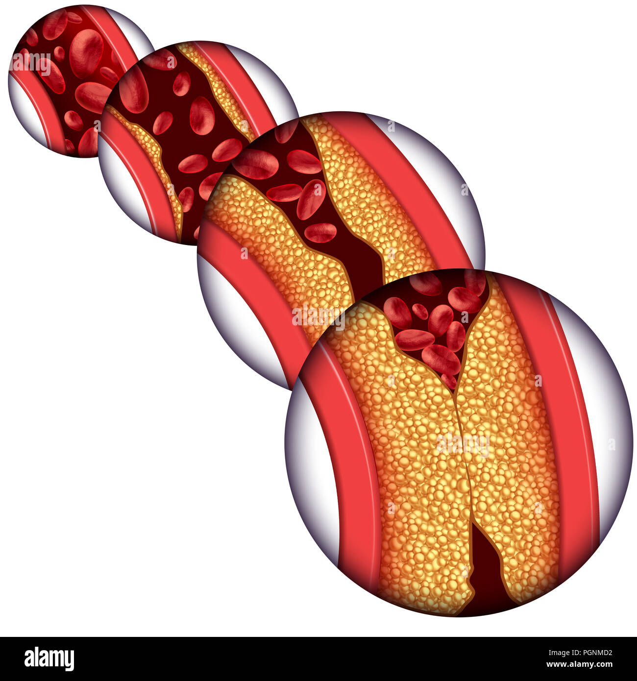 Arteria coronaria malattia malattia come un concetto medico con graduale formazione di placca risultante in arterie intasate e aterosclerosi. Foto Stock