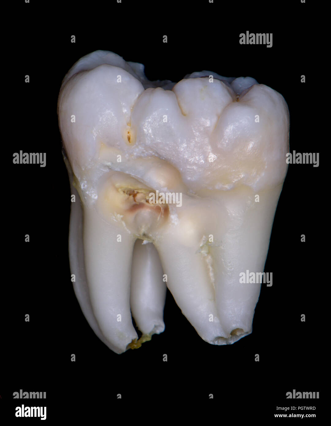 Dente di saggezza, inferiore sinistro molare, extra large, due denti in una fusione o gemination concrescentio? Foto Stock